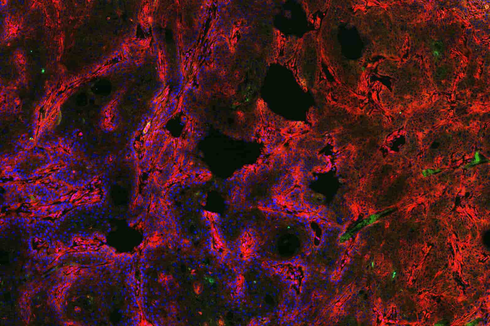cancer cells closeup